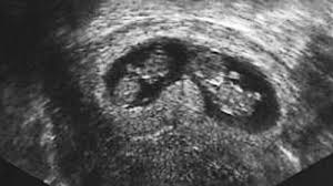 Zu beginn der fetalphase, die 1. Zwillinge In Der 11 Woche Ssw10 Babywelten Ch