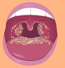 candida infections of the mouth throat