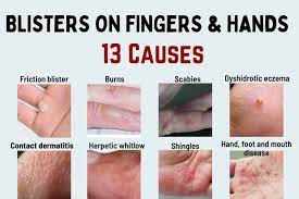 blisters on fingers and hands 13