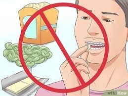 Dental braces are a type of orthodontic treatment used to correct teeth that are crowded, crooked, protruding, out of alignment or have irregular spacing. How To Make Your Braces Hurt Less With Pictures Wikihow
