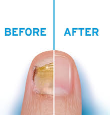 excilor treatment fungal nail treatment