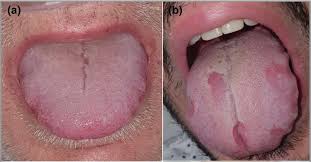 swollen tongue as a potential sign of