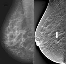 Excitement Builds Over Digital Breast Tomosynthesis