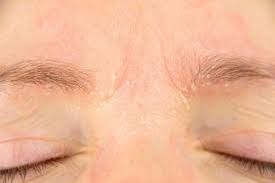 dry scaly eyelids lovetoknow health