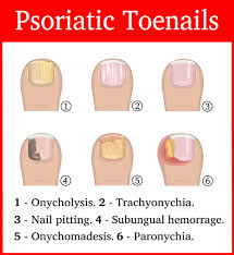 nail psoriasis ayurvedic psoriasis