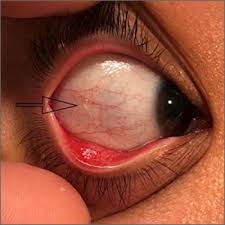 unilateral eye irritation mdedge