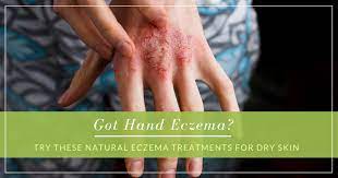 natural eczema treatments for dry skin