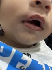 baby cut his lip need advice panicking