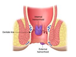 hemorrhoids hemorrhoid treatments