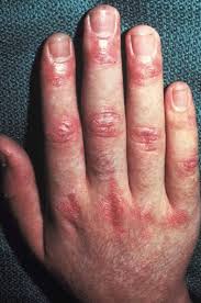 autoimmune disorders nail signs and