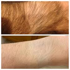 And Now For A Different Kind Of Timeline Arm Hair 7y Pre