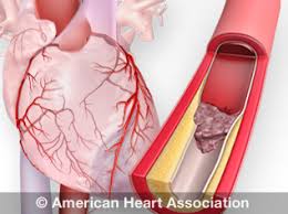 When that happens, blood stops flowing to the brain and other vital organs. Heart Attack And Sudden Cardiac Arrest Differences American Heart Association