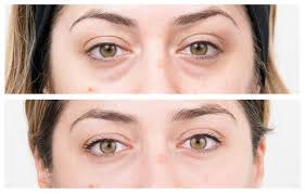 And under eye filler is one of the top treatments they're asked about. Everything You Need To Know About Non Surgical Eye Bag Removal