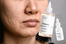 the ordinary s for acne scars
