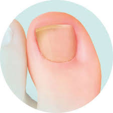 yellow toenails causes and treatment