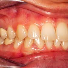 treat your gingivitis with 10 effective