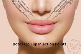 get your botox lip flip smile