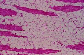 lipomas pathology orthobullets