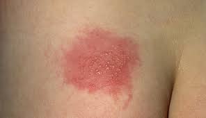 Hsv type 2 is the causative agent of herpes on buttocks. Herpes Simplex Virus 1 2 Clinical Advisor