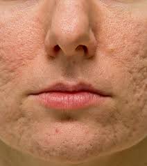 diffe types of atrophic acne scars