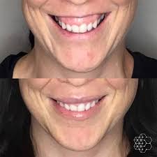 gummy smile treatment in vancouver bc