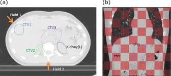 proton pencil beam scanning treatment