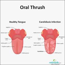 thrush causes symptoms and