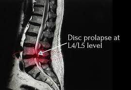 lower back pain the herniated disc