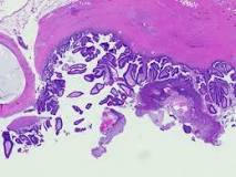 Image result for icd 10 code for ipmn of pancreas