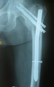 intramedullary hip for