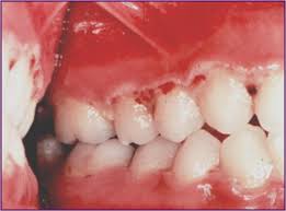 bacterial infection of the cavity