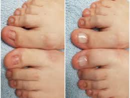 toenail reconstruction advanced foot