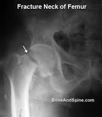 fem neck fractures presentation and