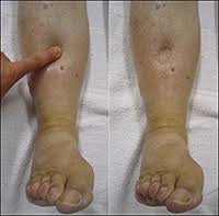 home remes for edema or water retention