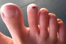 Toenail fungus can cause the nail to appear dark even black. Could A Black Spot Under The Toenail Be Fungus