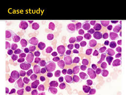         case study on leukemia