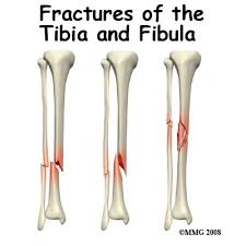 lower leg fractures physical