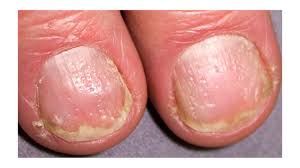 nail psoriasis symptoms pictures