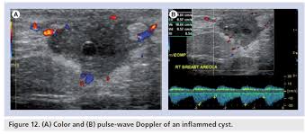 Color Doppler Sonography Characterizing Breast Lesions