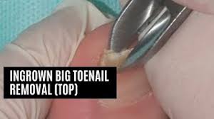 ingrown toenail surgery cost uk and