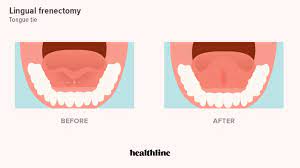 frenectomy procedure recovery and