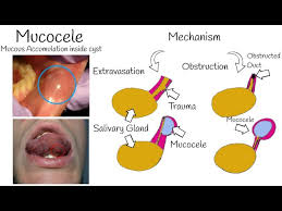 mucocele the most common mucosal