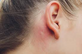ear eczema symptoms causes diagnosis