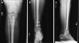 the infected tibial nail springerlink