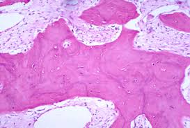 Chemotherapy, radiation therapy, hormonal therapies, complementary therapies are the major therapies used in the treatment of paget's afsar rahbar studies of the importance of cytomegalovirus infection in breast cancer ppt version | pdf version. Paget S Disease Pathology Orthobullets