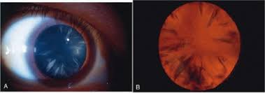 Clinical Evaluation Of Cataracts Ento Key
