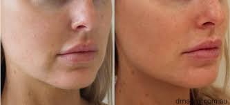 Lifting the cheeks also naturally lifts the skin around the jawline and corners of the mouth. Marionette Chin And Jawline Dermal Filler Injections Best Clinic Sydney For Dermal Fillers