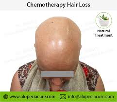 chemotherapy hair loss treatment