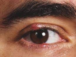why you should never pop a stye