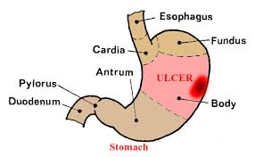 stomach ulcer treatment with home
